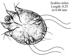 Infection par la gale