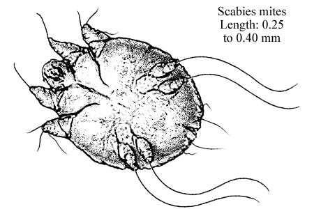 Infection par la gale